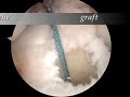 ACL Repair