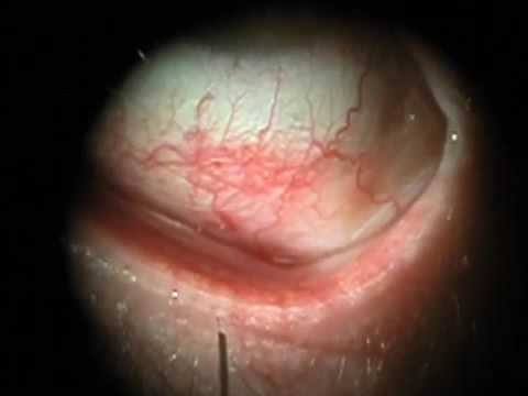 how to relieve dry eyes