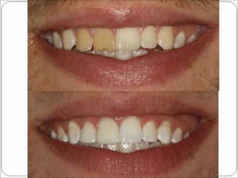 how to whiten implant teeth