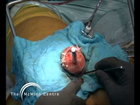 how to eliminate osteophytes
