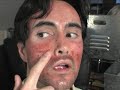 Laser skin resurfacing