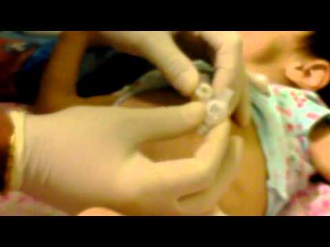 how to vent a mickey button