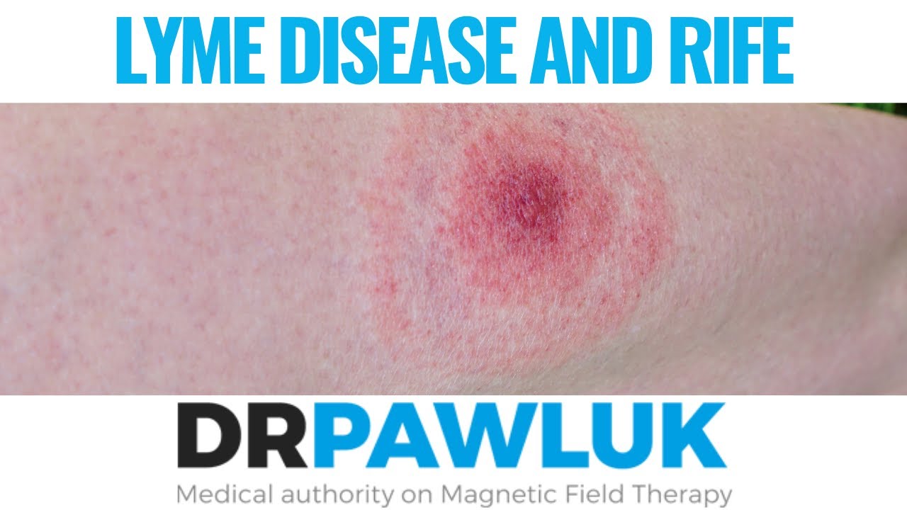 Lyme Disease and RIFE Machines - Can they Help?