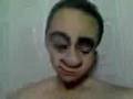 videos de deformosis cronica