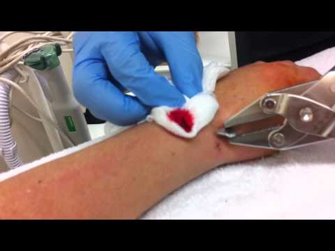 how to remove k wires