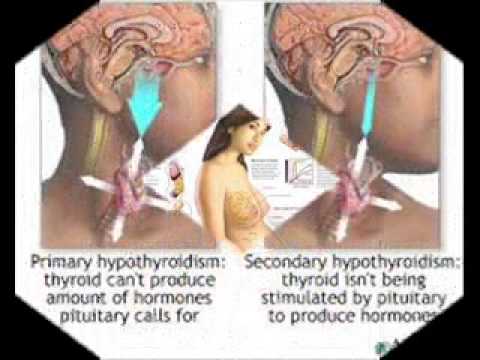 how to cure thyroid naturally