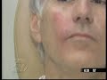 Juvederm Injectable Filler - Naples Florida