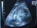 25 weeks U/S It\