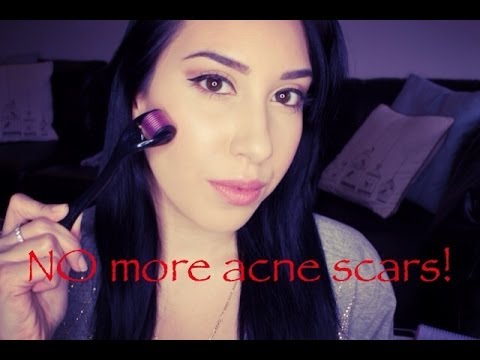 how to get rid of acne scars uk
