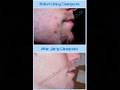 ClearPores - Goodbye Acne forever