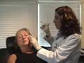 Cheek Augmentation Radiesse Monarch Bay Laser in Dana Point, Ca. Daniel C. Mills MD,FACS