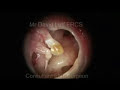 subtotal tympanic membrane perforation