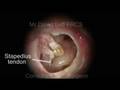 subtotal tympanic membrane perforation