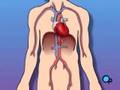 PreOp® Patient Education Balloon Angioplasty Coronary