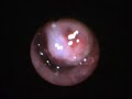 Bronchoscopic Video Clips - Dr. P.N. Agrawal , Bhopal