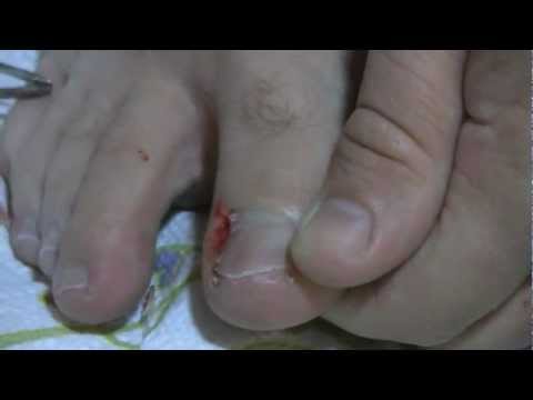 how to get rid of an ingrown toenail