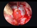 Cystic PRLoma - Pituitary Adenoma Cystic PRLoma - Pituitary Adenoma