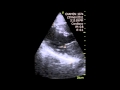 Myxoma Of The Left Atrial Compartment