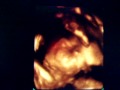 3D ultrasound