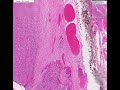 Histopathology Thyroid--Follicular carcinoma Histopathology Thyroid--Follicular carcinoma