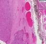 Histopathology Thyroid--Follicular carcinoma