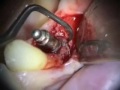Implant Microsurgery: Periimplant Repair of Implant Overdenture Abutment