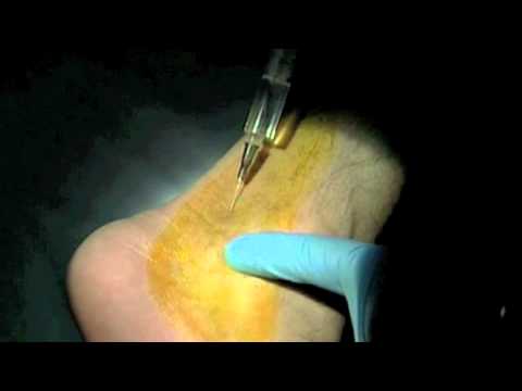 Infiltracion Sindrome del canal tarsiano con Ozono Medico