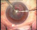 my-lasik-eye-surgery.html