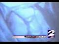 Single-Visit Dental Onlay -Crowns (CEREC)-Houston dentist