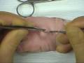 Excise sebaceous