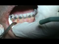 Extraction Space Fiberotomy