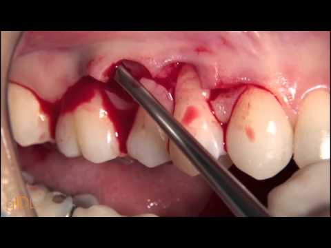 how to treat gingivitis