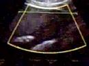 35 wk ultrasound of Ava
