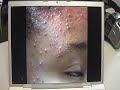 The Acne Practice (African American 2) The Acne Practice (African American 2)
