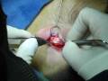 videos de In the Operating Room - Harvesting Ear Cartilage for Rhinoplasty