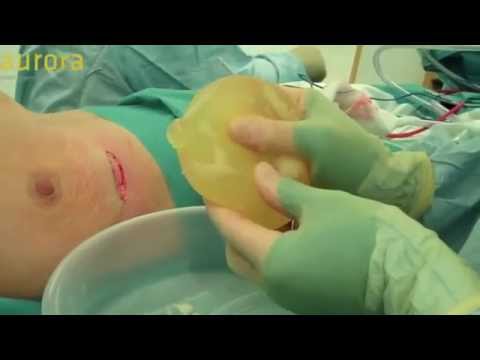 how to detect silicone implant leak