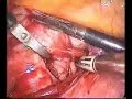 laparoscopic myomectomy included in the broad ligament laparoscopic myomectomy included in the broad ligament