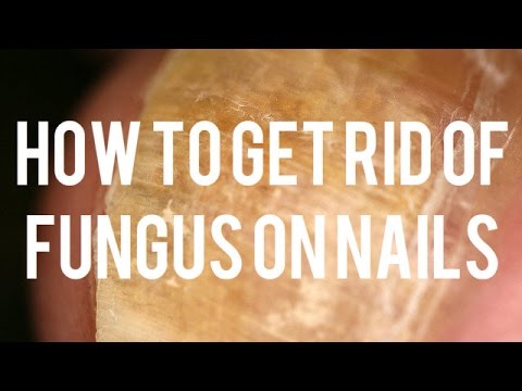 how to get rid of fungus quick