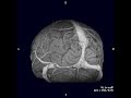 3D Brain Image