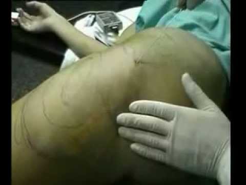 Video > Laserliplisis: lipoescultura asistida por lser 