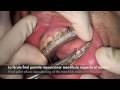 Cirurgia Ortognática Bimaxilar