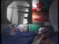 Application of Rail Fixator for Non Union Part 2