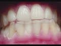 Dental Bleeching: White Teeth: beautiful results in Belgium