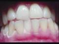 Dental Bleeching: White Teeth: beautiful results in Belgium