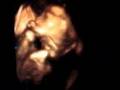 Zoita's 4d ultrasound teaser 20w5d