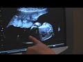Gender Ultrasound (16 weeks, 4 days)