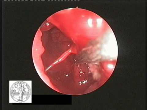 how to treat eosinophilic folliculitis