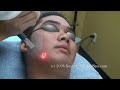 Laser Acne Scar Removal Filipino Patient Laser Acne Scar Removal Filipino Patient
