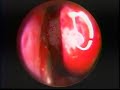 Endoscopic Intranasal Maxillary Sinus Antrostomy