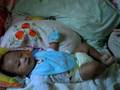 augmentin rash toddler